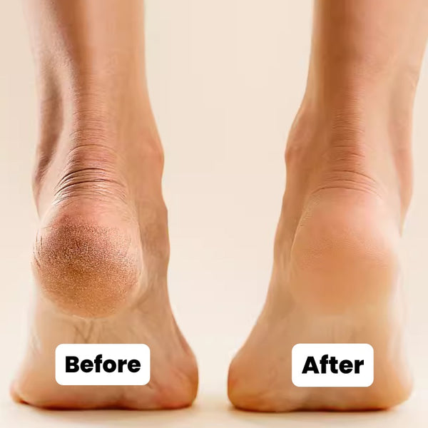 SilkyPed Ultimate Foot Skin Remover