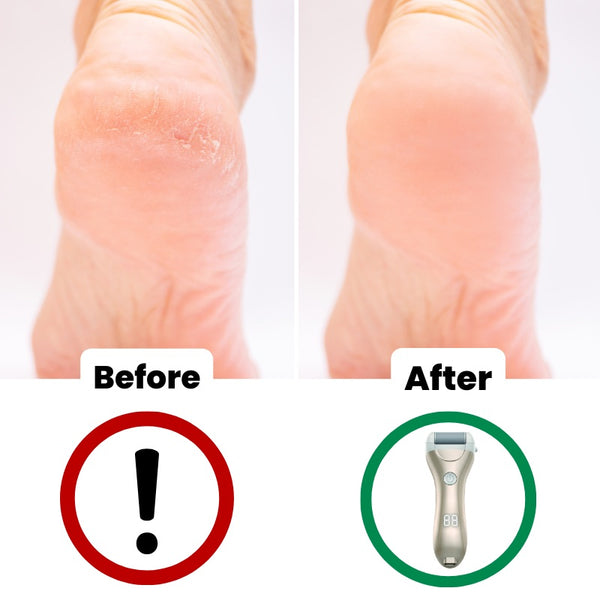 SilkyPed Ultimate Foot Skin Remover